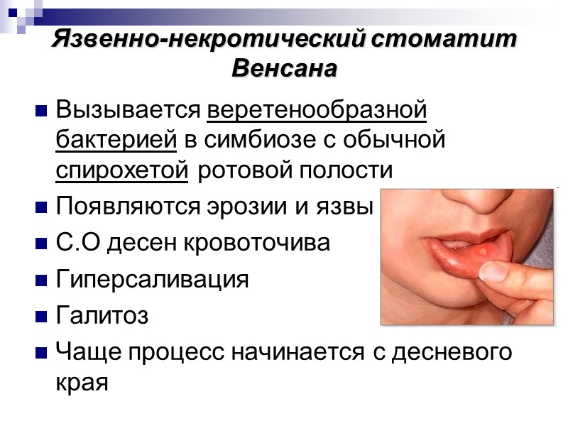 Язвенно-некротический стоматит Венсана Вызывается веретенообразной бактерией в симбиозе с обычной спирохетой ротовой полости Появляются